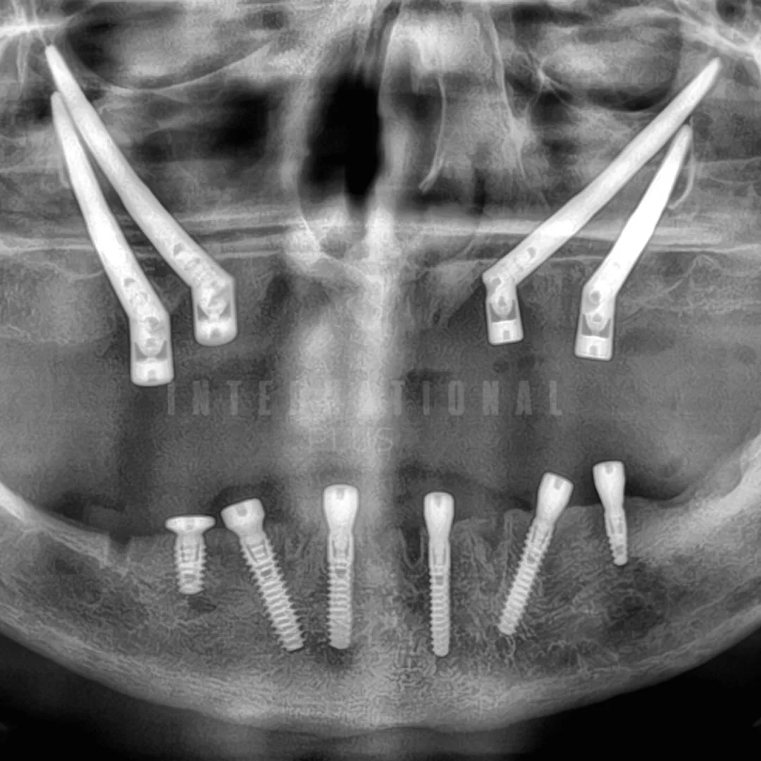 Understanding Zygomatic Implants Advanced Solutions for Severe Maxillary Atrophy