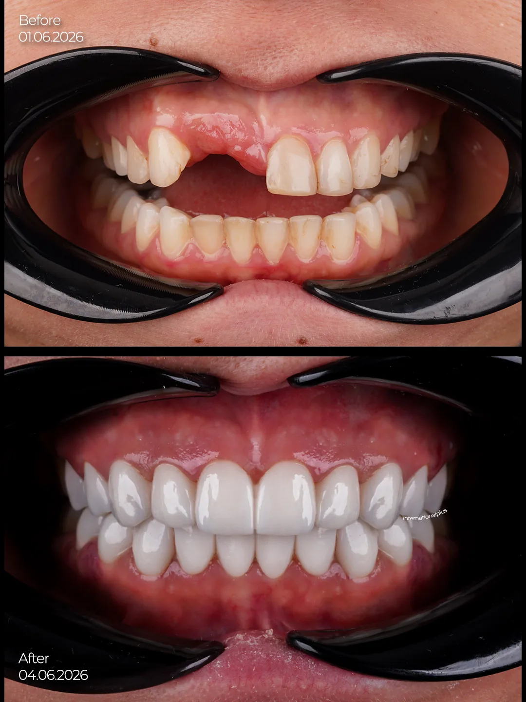 Camila's Story Years Behind a Removable Denture