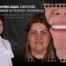 Escaping Dual Denture Dependence in Turkey, Istanbul Comprehensive Full Arch Rehabilitation for Challenging Anatomy