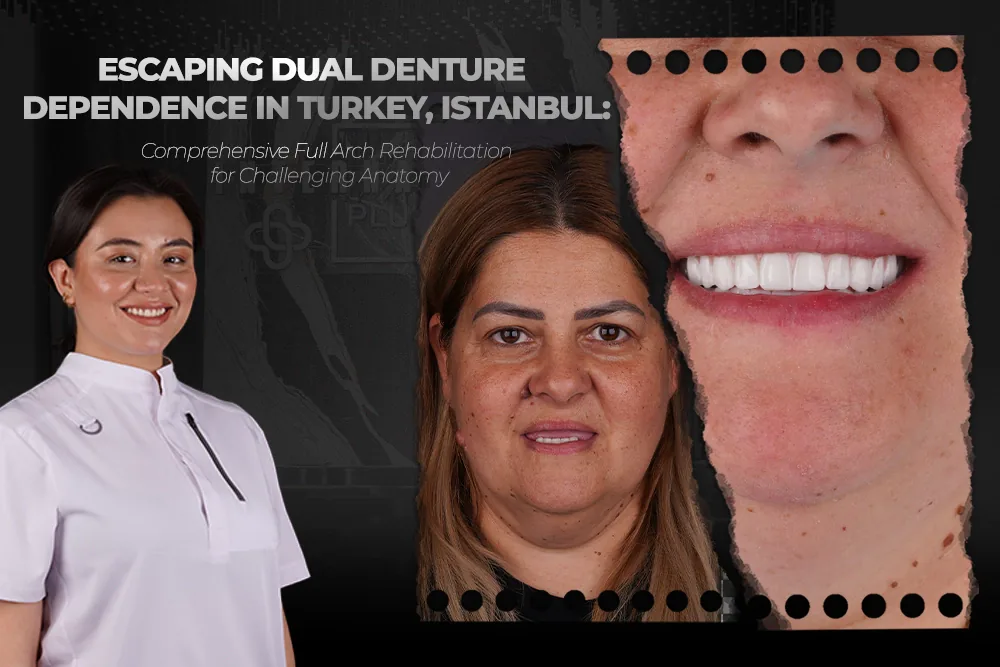 Escaping Dual Denture Dependence in Turkey, Istanbul: Comprehensive Full Arch Rehabilitation for Challenging Anatomy