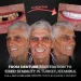 From Denture Frustration to Fixed Stability in Turkey, Istanbul Full Arch Rehabilitation for the Elderly Patient