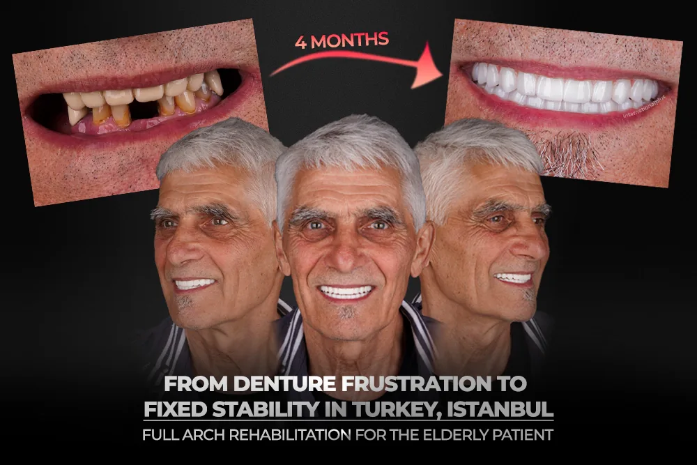 From Denture Frustration to Fixed Stability in Turkey, Istanbul: Full Arch Rehabilitation for the Elderly Patient