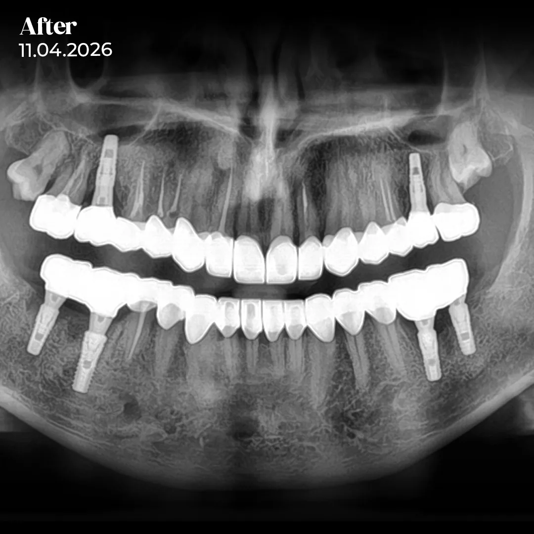 Second Visit Digital Workflow and Definitive Restoration