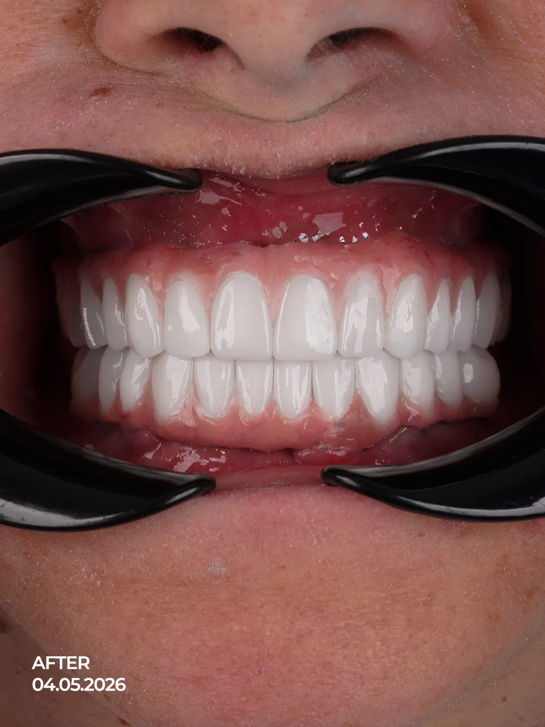 Surgical Phase Extraction, Augmentation, and Strategic Implant Placement