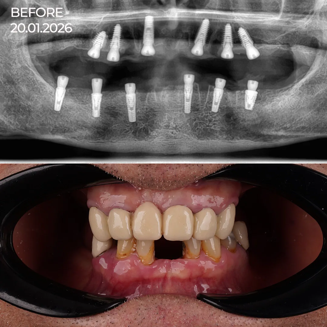 The Denture Dilemma Why Removable Prosthetics Fail to Satisfy