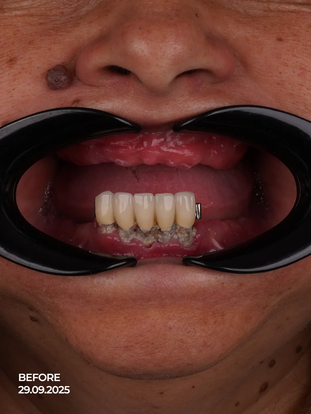 The Dual Denture Challenge Compounding Frustrations Across Both Arches