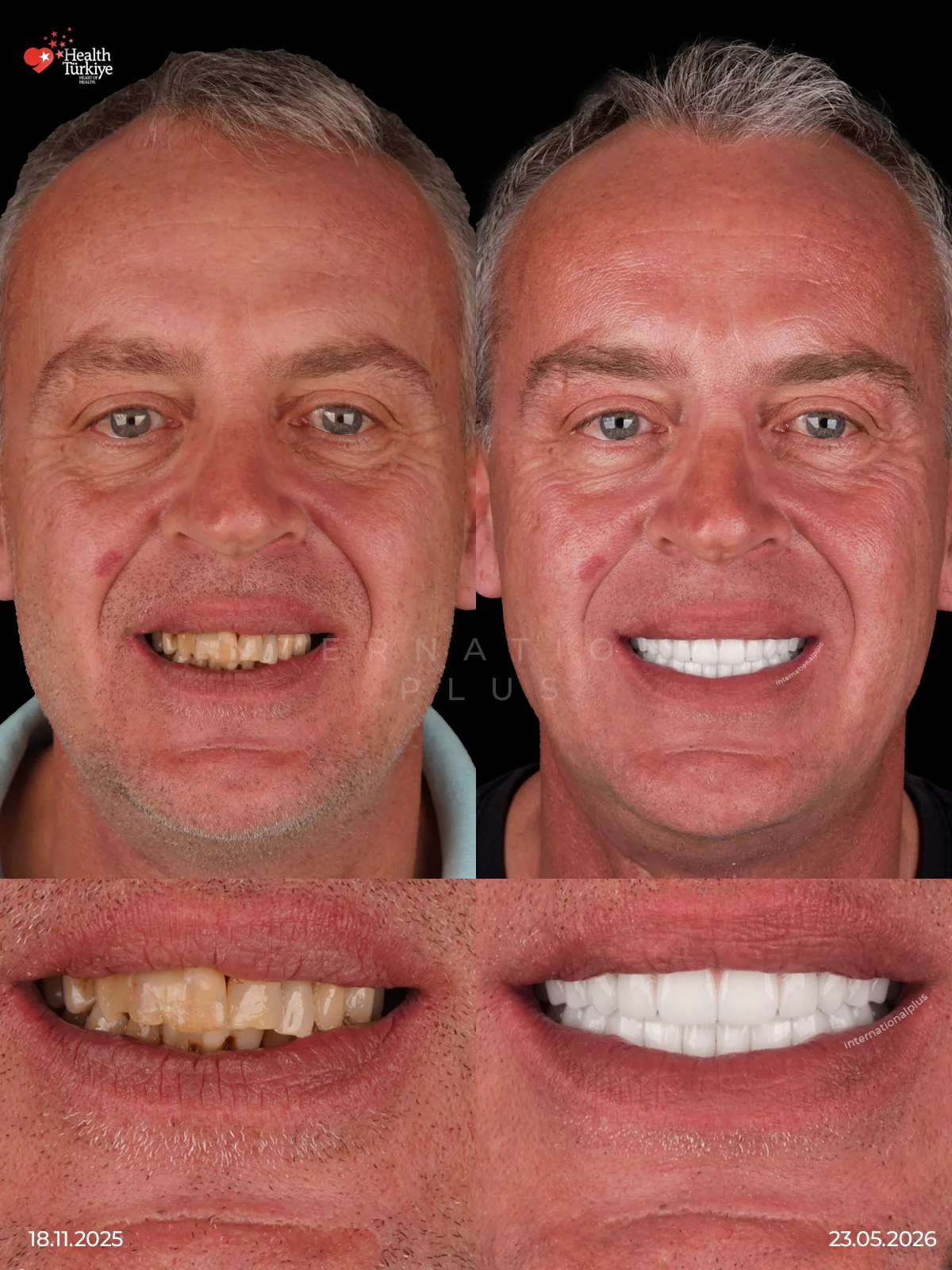 A Dental Journey from Germany