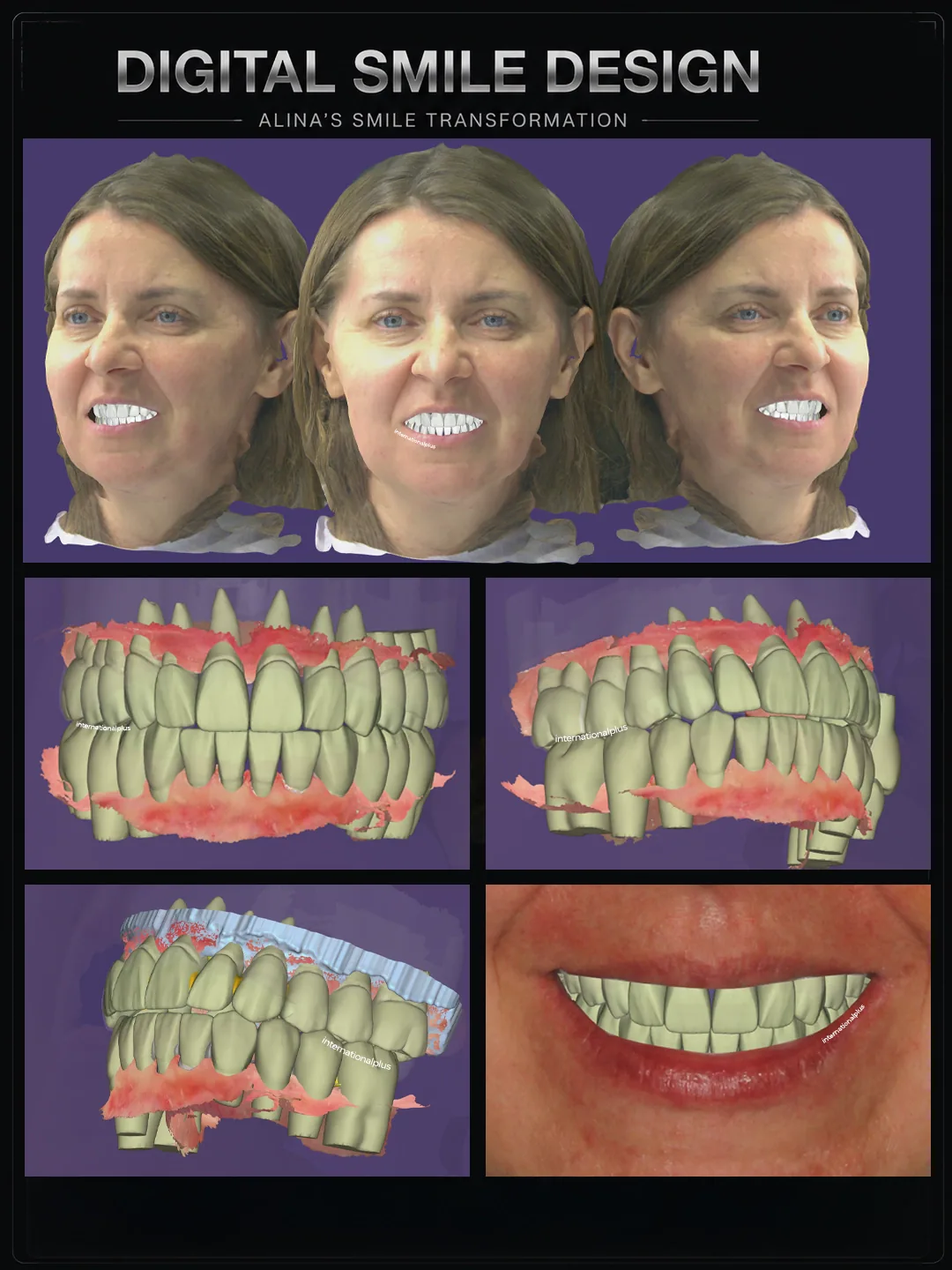 Alina's Story Two Decades of Failing Crowns