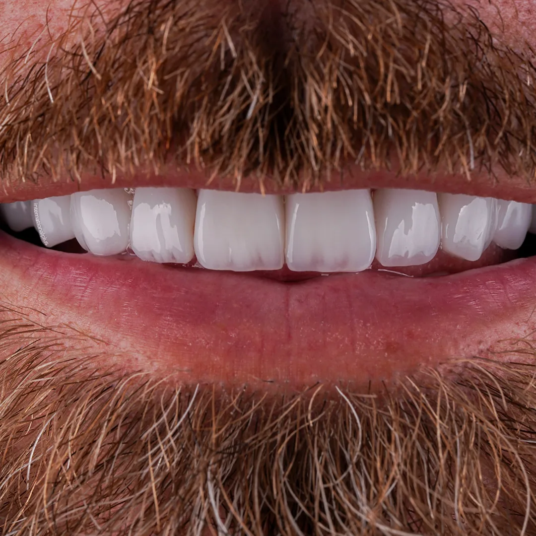 Crafting 18 Ivoclar E.max Restorations