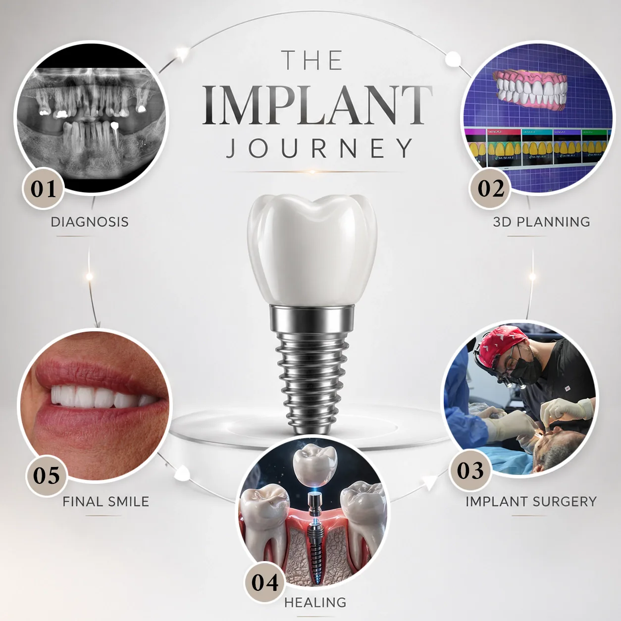 Dental Implant Before After 2026