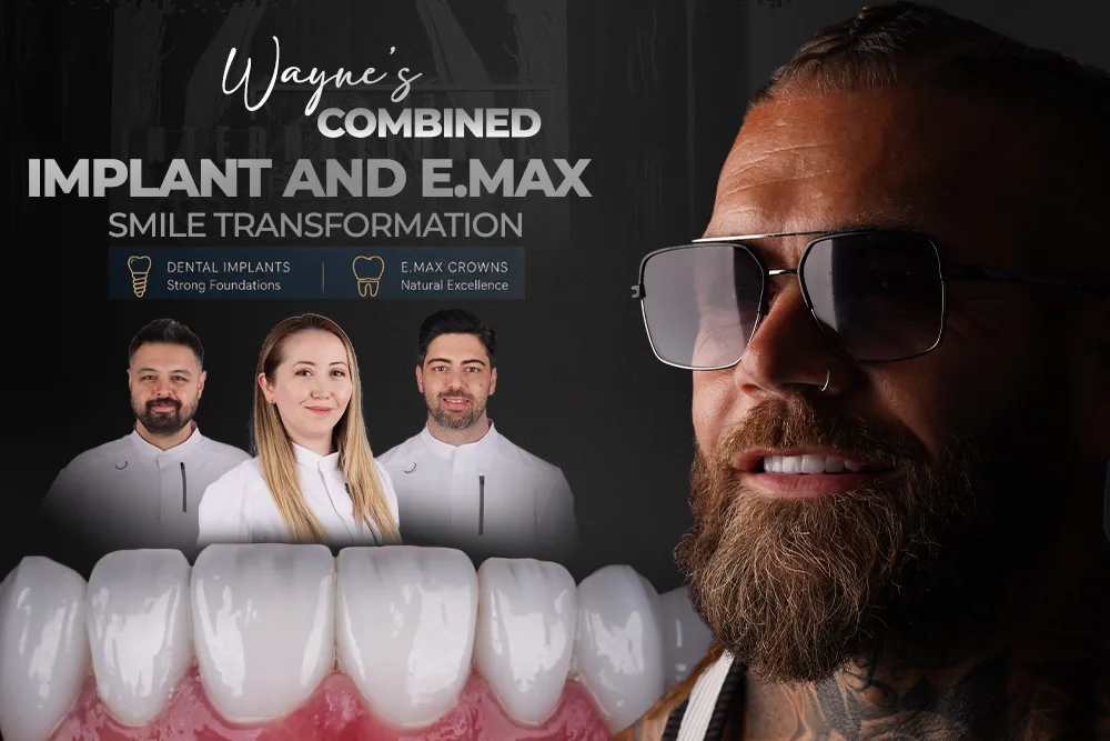 E.max Smile Transformation: Wayne’s Implant Case Study