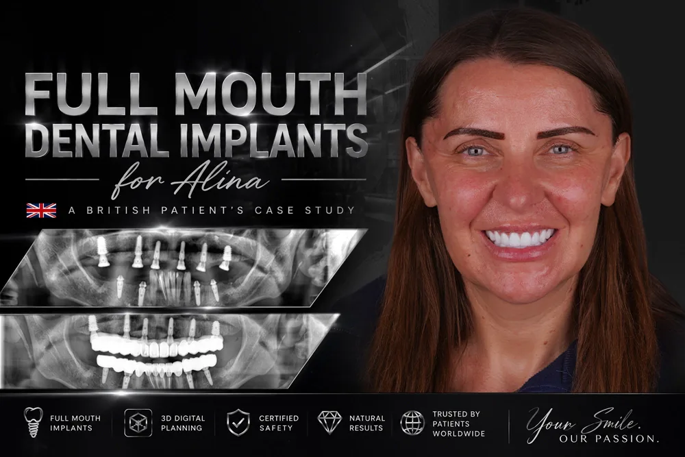 Full Mouth Dental Implants: Alina’s All on 6 Case Study