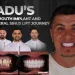 Full Mouth Dental Implants Case Study Radu’s Journey