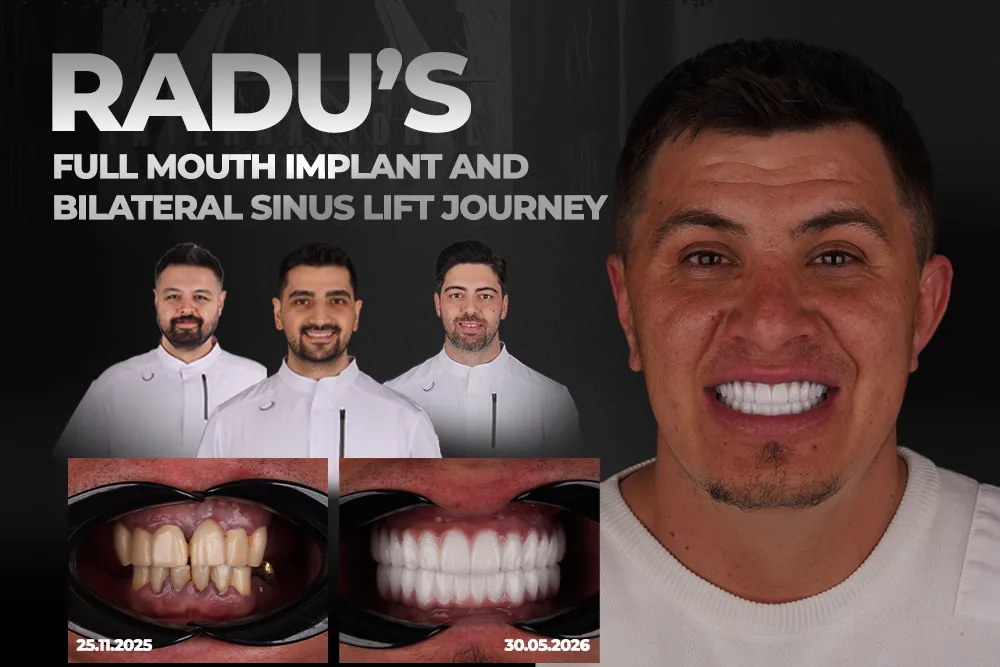Full Mouth Dental Implants Case Study: Radu’s Journey