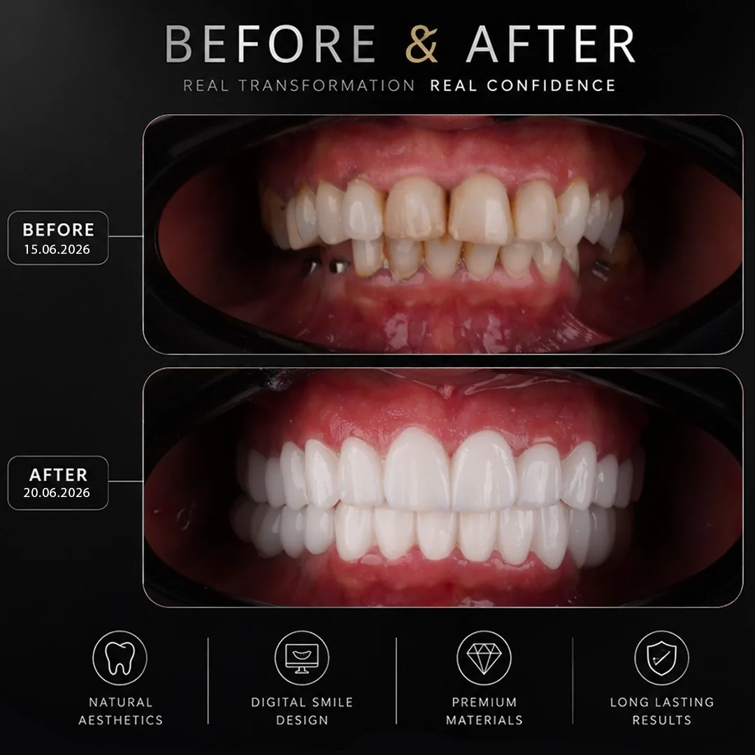 Full Mouth Reconstruction 2026