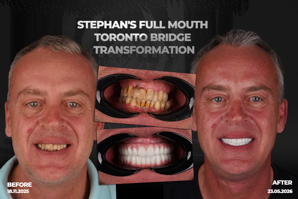 Full Mouth Toronto Bridge Case Study: Stephan’s Journey