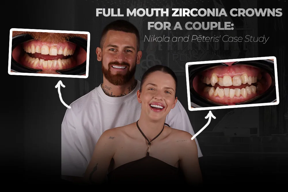 Full Mouth Zirconia Crowns: A Couple’s Case Study in Turkey