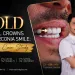 Gold Dental Crowns and Zirconia Keith's Case Study