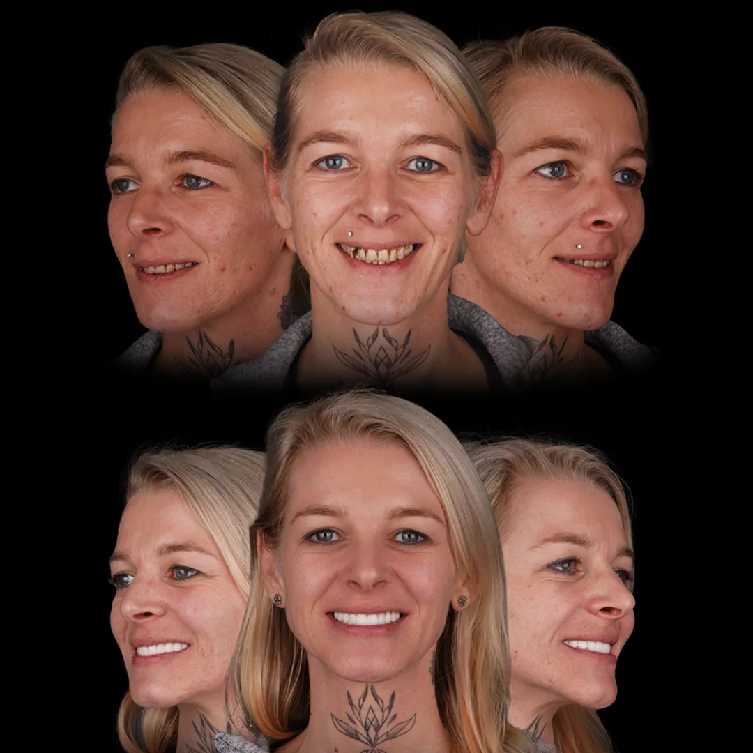 Hollywood Smile Before After 2026