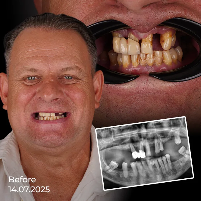 How Were Same Day Dental Implants Placed for Dennis