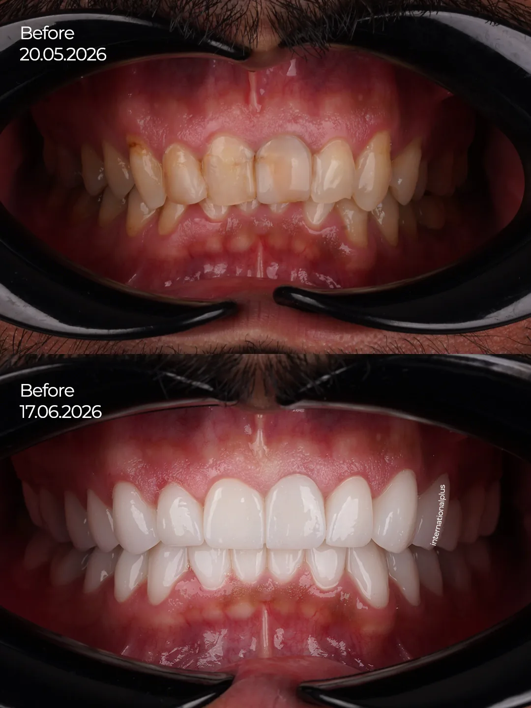 Leveling the Gums and Rebuilding the Foundation