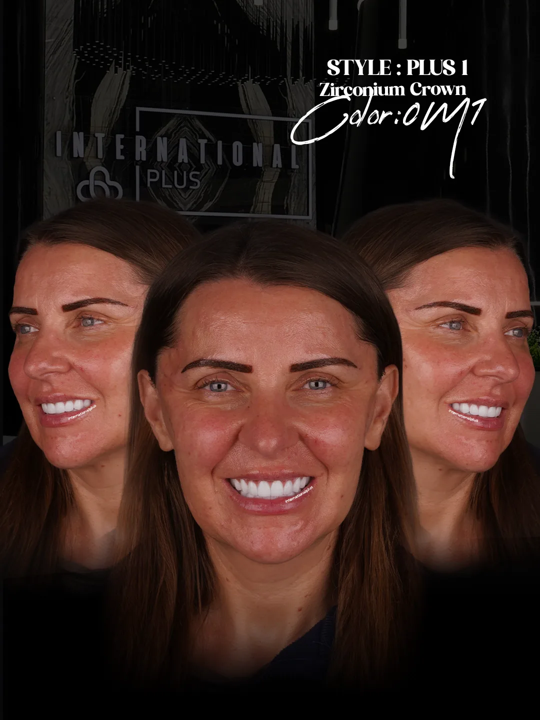 Rebuilding the Upper Jaw with the All on 6 Concept