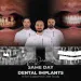 Same Day Dental Implants Dennis's Bar Supported Case