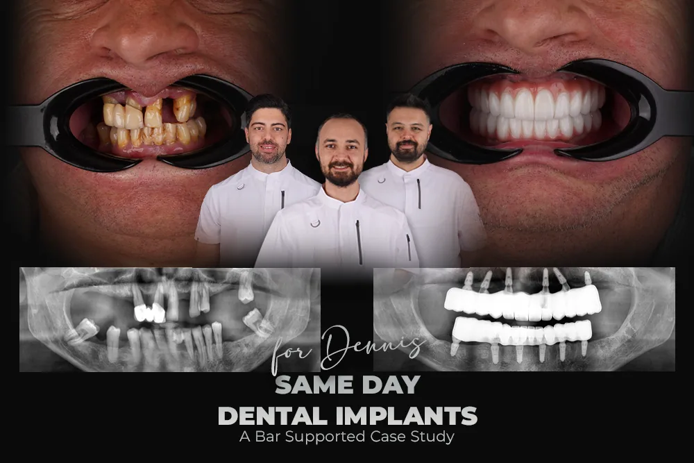 Same Day Dental Implants: Dennis’s Bar Supported Case