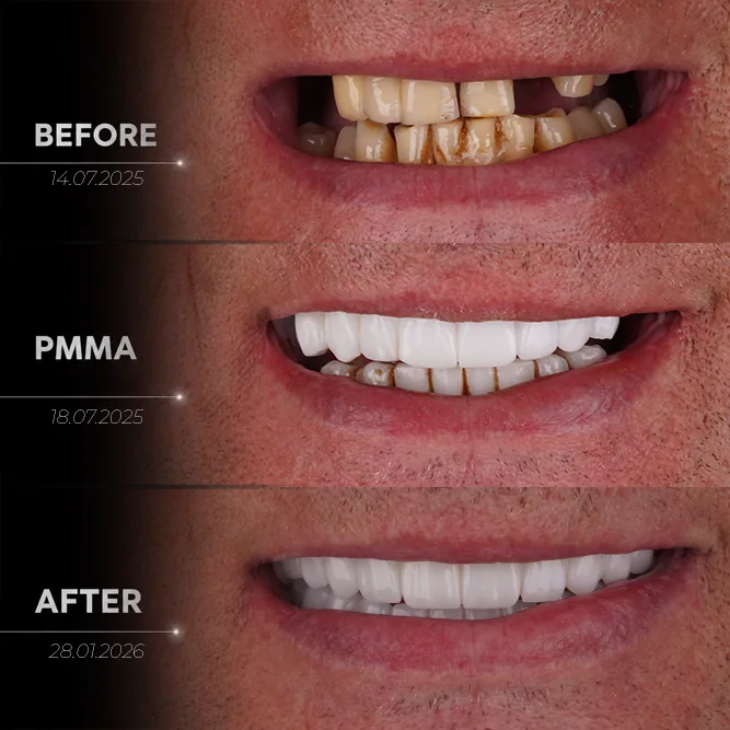 The Result A Definitive Fixed Prosthesis in About a Week