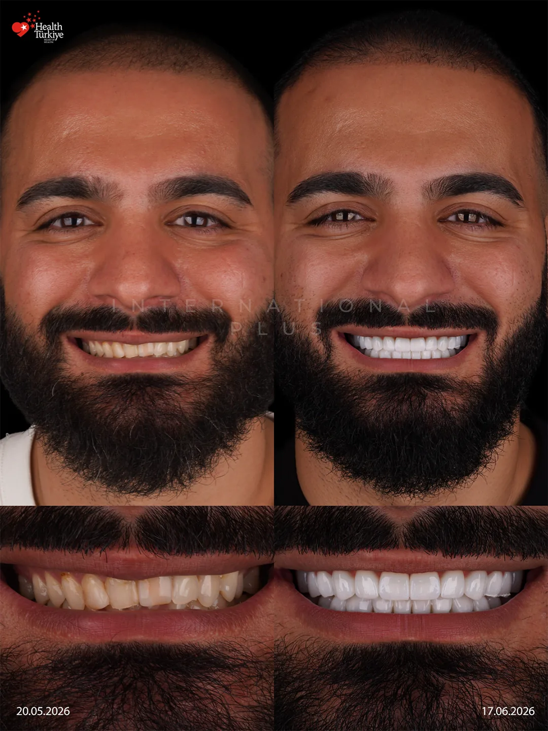 The Result A Natural, Confident Smile