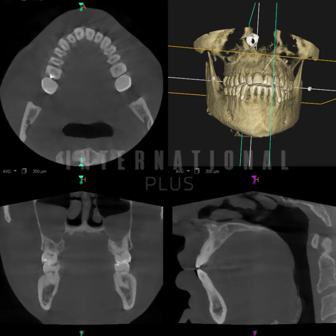 The Result A Rebuilt, Functional Smile