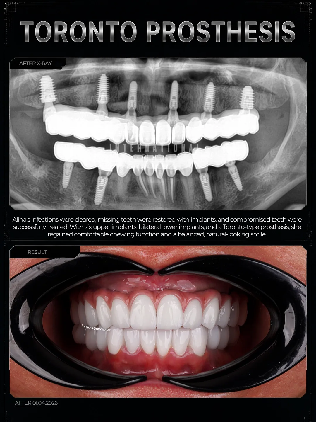 The Result Function, Comfort and a Lasting Prosthesis