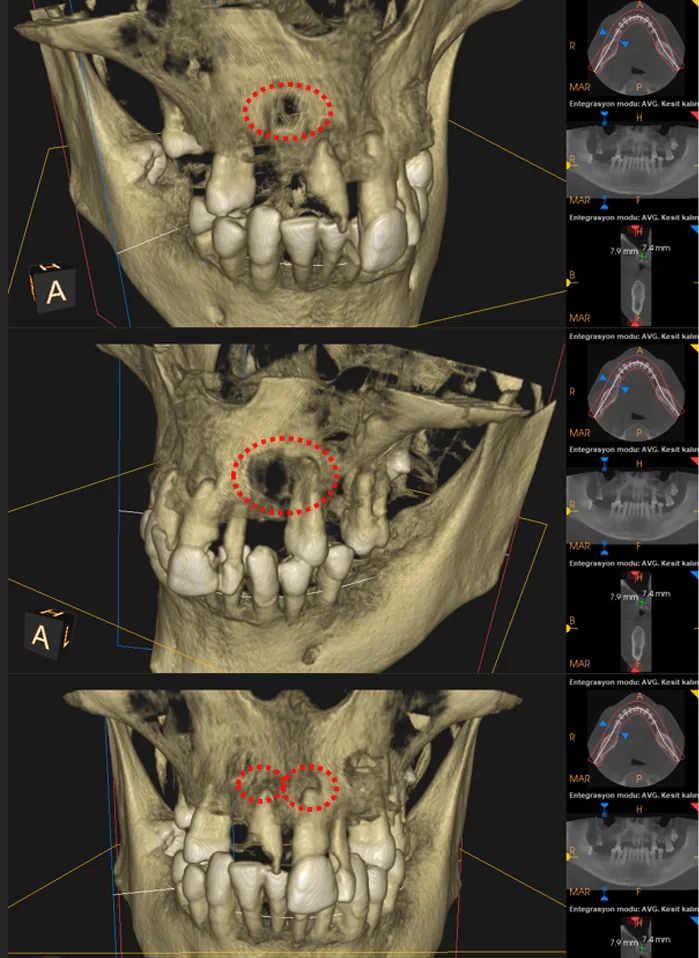 The Surgery Cyst Removal, Sinus Lifting and 12 Implants