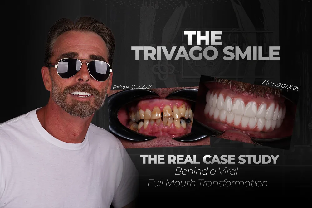 The Trivago Smile: A Viral Full Mouth Implant Case Study