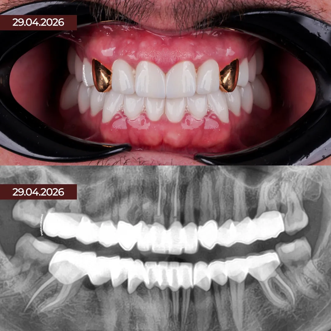 Why Combine Gold Dental Crowns With Zirconia