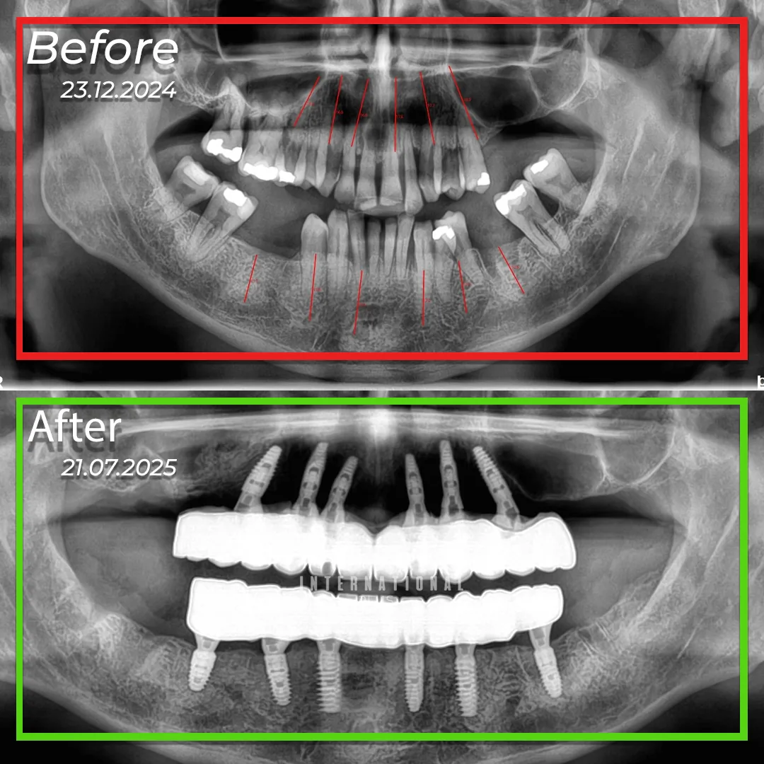 Diagram of bilateral sinus lifting and twelve implants placed for a full mouth rehabilitation.