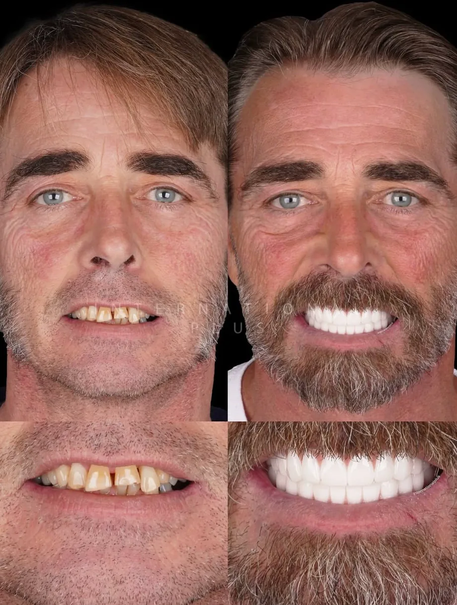 Titanium bar reinforced zirconia full arch bridge produced in the International Plus laboratory.