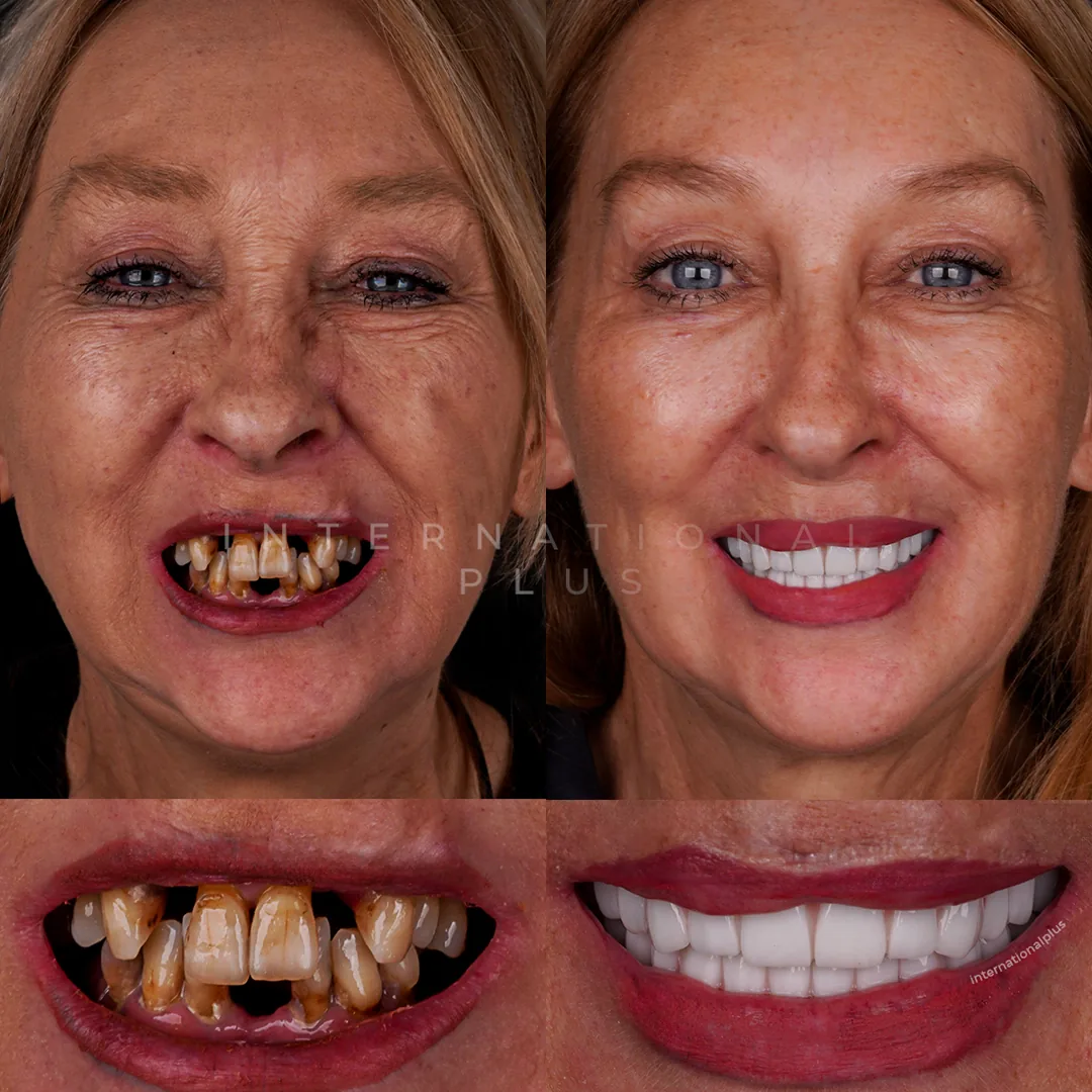 Bar Supported or Direct Screw Retained Which Design Suits a Long Arch