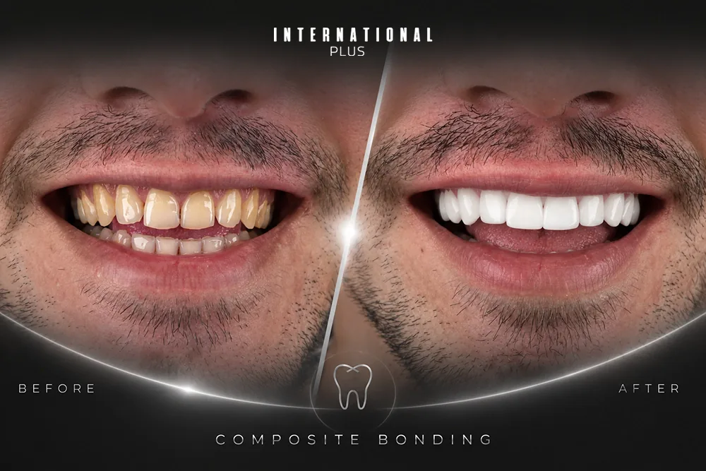 Composite Bonding Turkey: A Less-Invasive Alternative