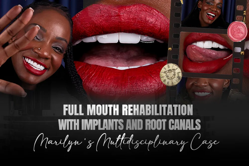Full Mouth Rehabilitation With Implants and Root Canals