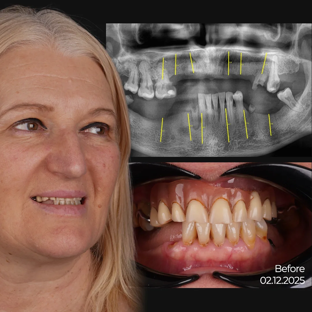 How Did Sedation Dentistry Make Full Mouth Surgery Possible