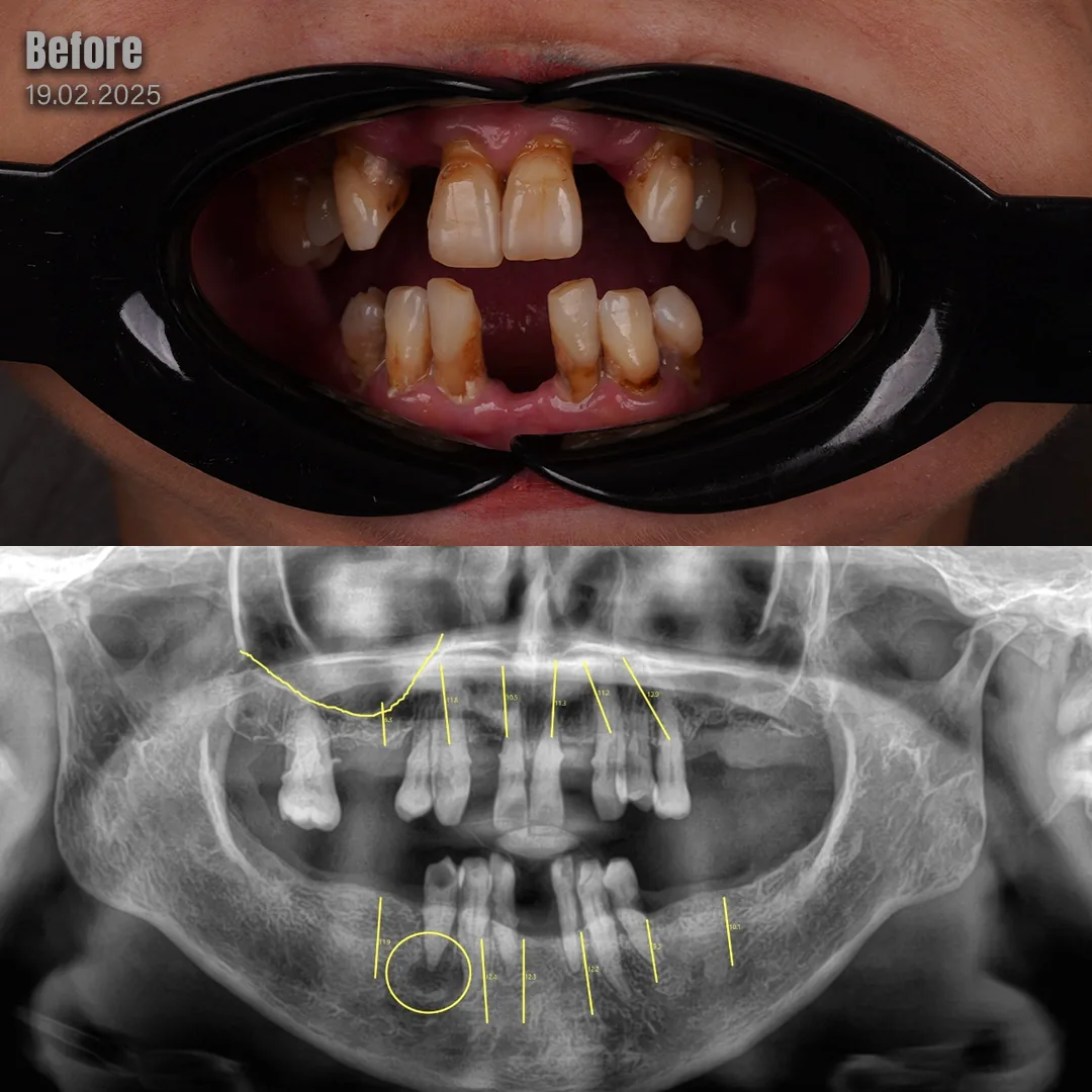 How Is Occlusion Managed When Both Arches Are Rehabilitated