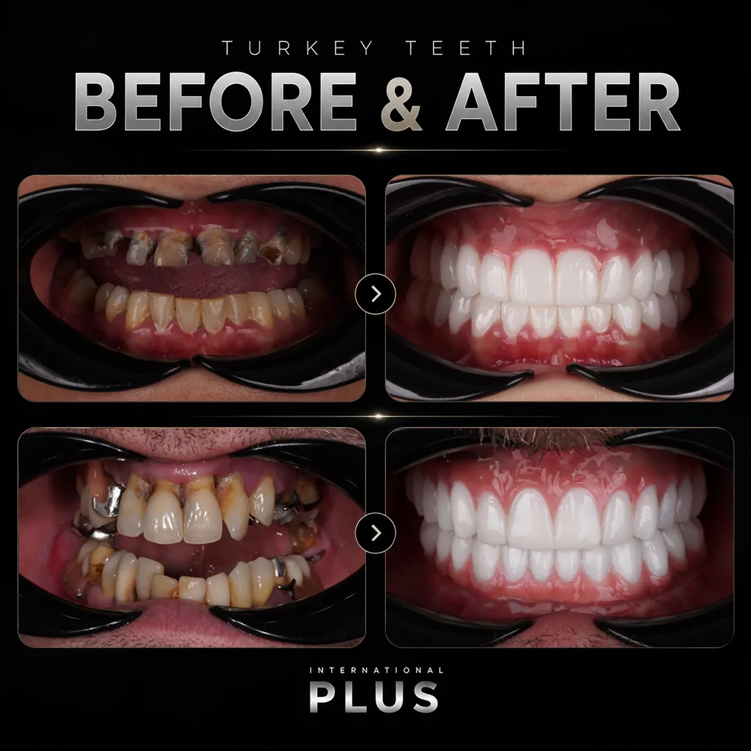 How Our Clinic Plans a Natural Turkey Teeth Result