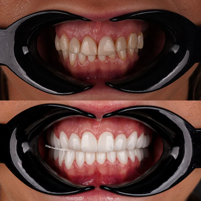 How Were the Impressions Taken and the Zirconia Built