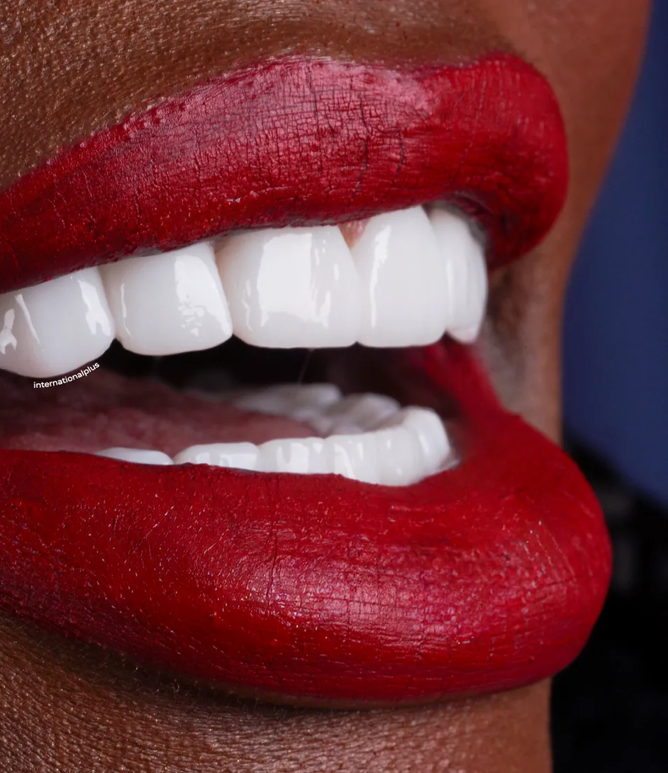 Marilyn's Story A Reset That Kept Her Own Teeth