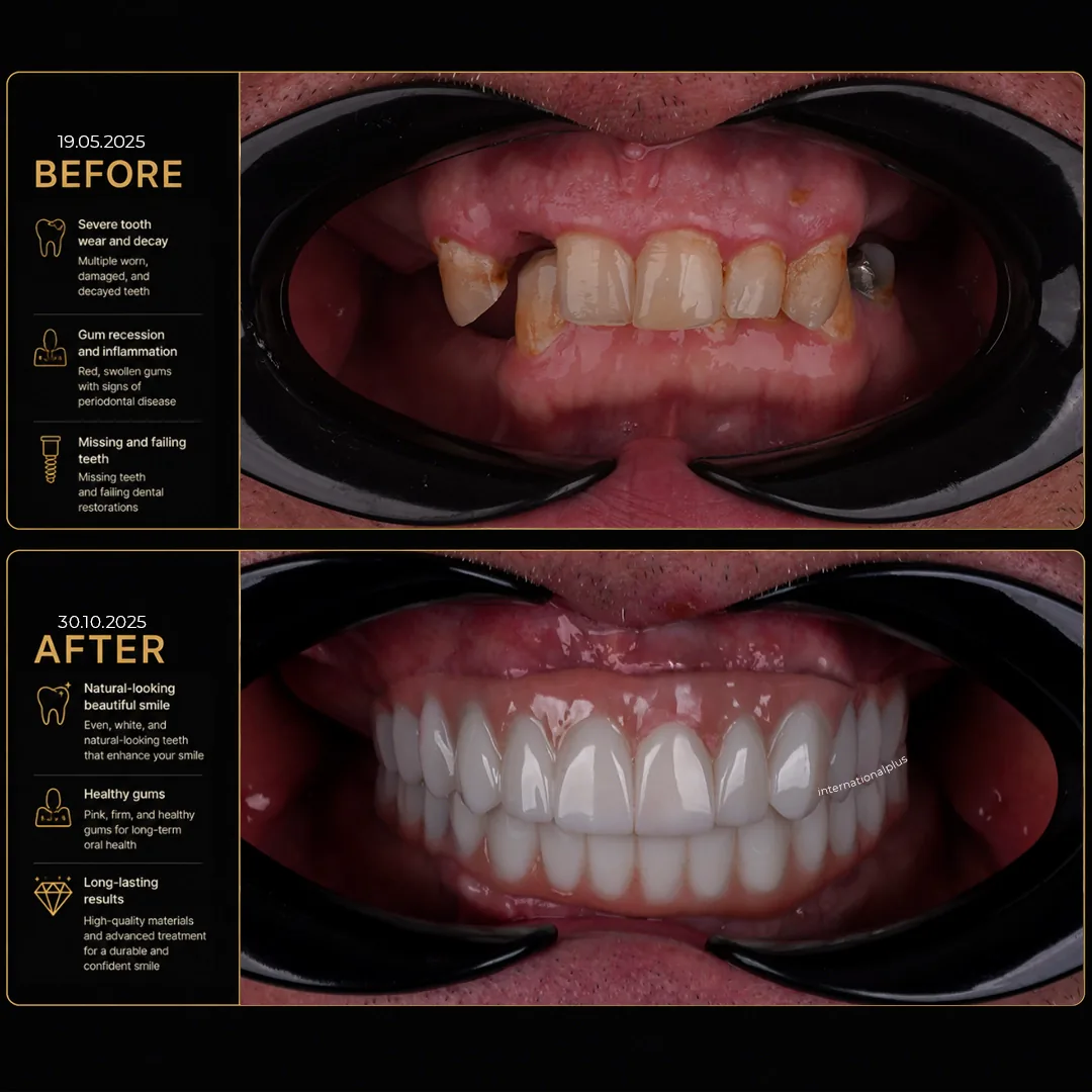 Placing the Zygomatic and Dental Implants Anchoring in the Cheekbone