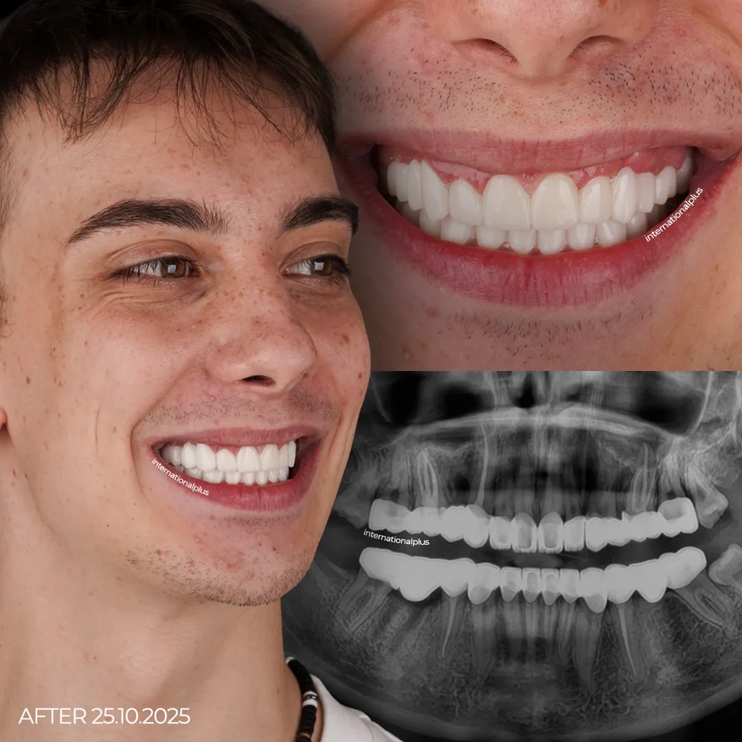 Saving the Teeth Root Canals, Fillings and Minimally Invasive Prep