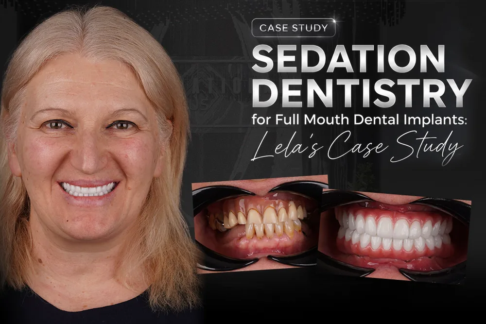 Sedation Dentistry for Full Mouth Implants: Lela’s Case