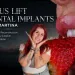 Sinus Lift Dental Implants Martina's Full Mouth Case