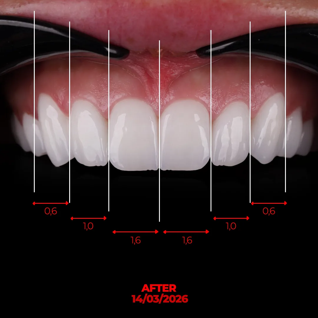 The Prosthetic Phase 26 Zirconia Units, Gum Aesthetics and a Staged PMMA Trial